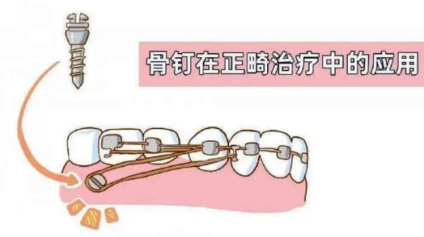 四、张家港珂润口腔的种牙反馈稳在哪里