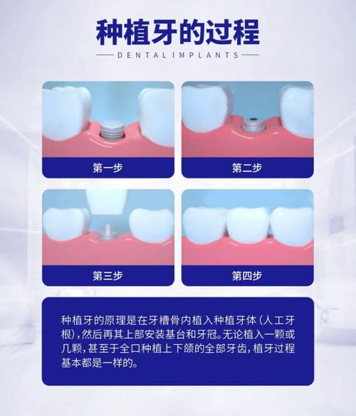 徐州瑞博医院口腔科预约挂号怎么约？2026年三步在线预约不用排队，种植牙3479元起，兰春祥医生技术稳，周末也能约，平价收费不踩坑
