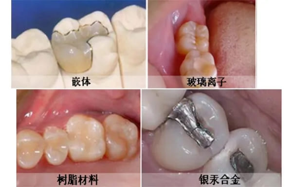 二、抚州英伦口腔医院补牙价格贵不贵?进口树脂188元起算不算高