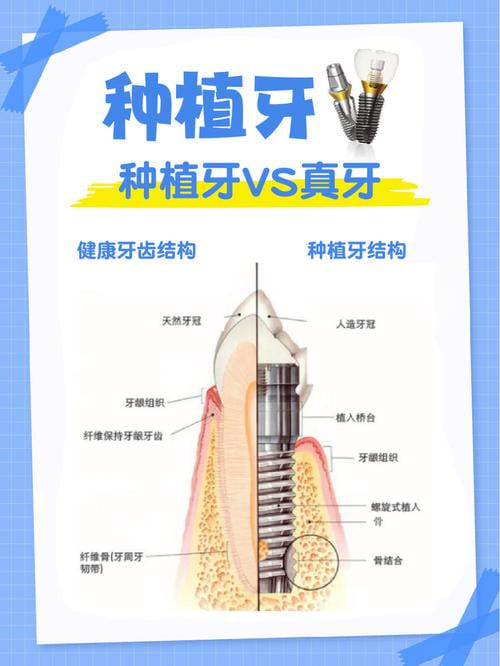 上海翊嘉口腔种植牙技术好吗？2026年实测高难度种植当天啃排骨真香，价格透明服务贴心靠谱！